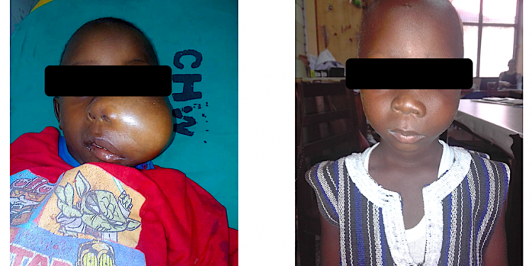 Photo: A child with Burkitt Lymphoma, a common blood cancer in Ghana – Before and After Treatment. He was treated with cheap anti-cancer medicines over a period of 8 months. The overall cost of treatment was less than a tenth of the cost of treating breast cancer. Breast cancer treatment is covered by NHIS but Burkitt Lymphoma is not covered.