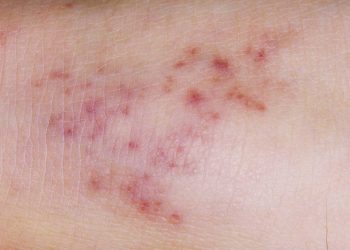 File image of a patient suffering Meningitis.