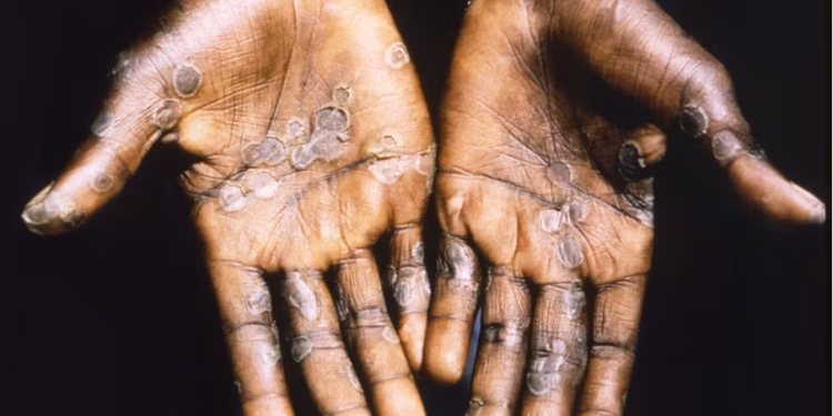 The palms of a patient during an outbreak of mpox in the Democratic Republic of Congo in 1997. Getty Images