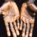 The palms of a patient during an outbreak of mpox in the Democratic Republic of Congo in 1997. Getty Images