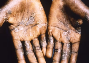 File image of Mpox symptoms