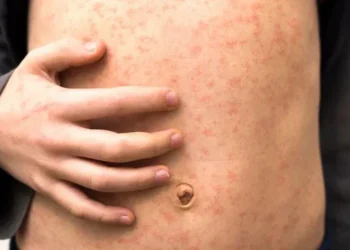 Measles outbreaks, Getty images